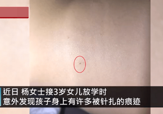幼兒園3歲女童身上現(xiàn)29處針眼1.jpg